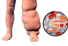 Mengenal Filariasis, dari Gigitan Nyamuk Menjadi Kaki Gajah