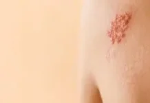 Mengenal Penyebab, dan Cara Mengatasi Herpes